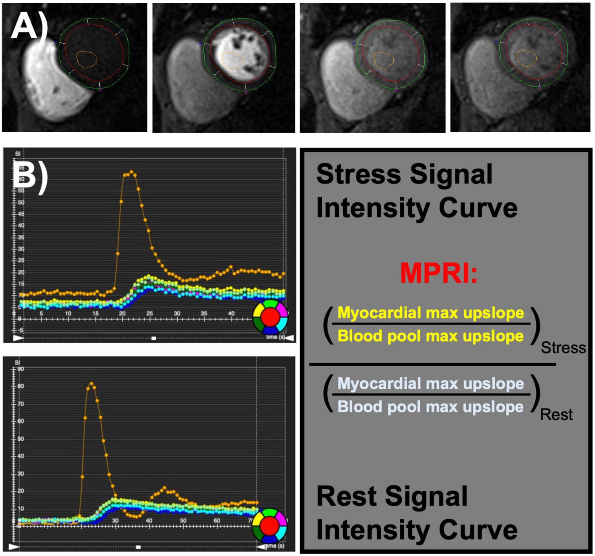 Sex differences in contributors to coronary microvascular dysfunction